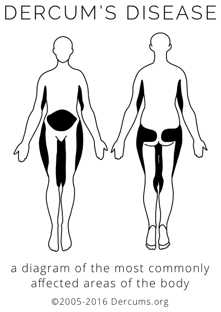 A diagram of the areas of the body most commonly affected by Dercum's Disease - the upper arms, thighs, and distinctive shapes on the abdomen, buttocks, and hips.